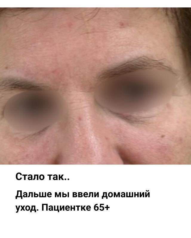 רפואה אסתטית / הזרקות ראשון לציון - Косметолог Ольга Вайнберг Ришон