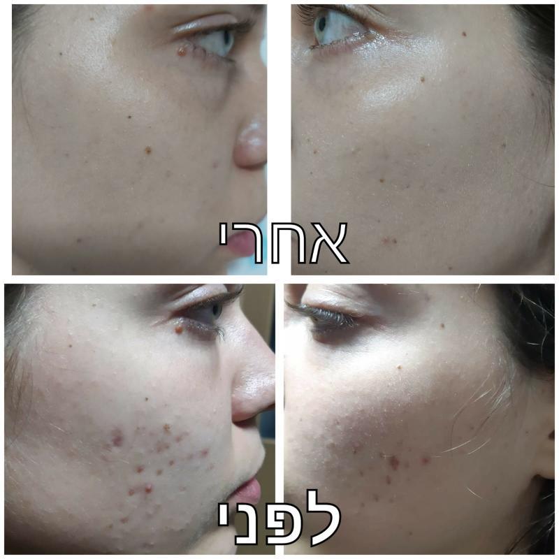 קוסמטיקה (ללא הזרקות) רחובות - NK BEAUTY LOUNGE