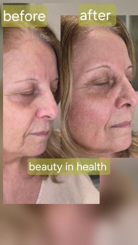 רפואה אסתטית / הזרקות חיפה - Beauty in health