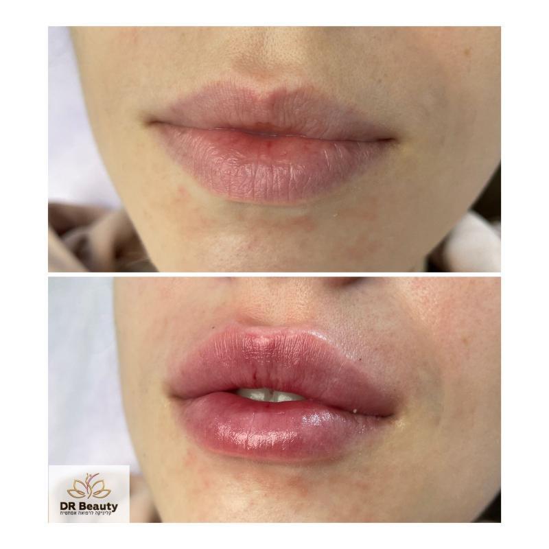 רפואה אסתטית / הזרקות קריית ביאליק - Dr Beauty ד"ר ביוטי מכון יופי