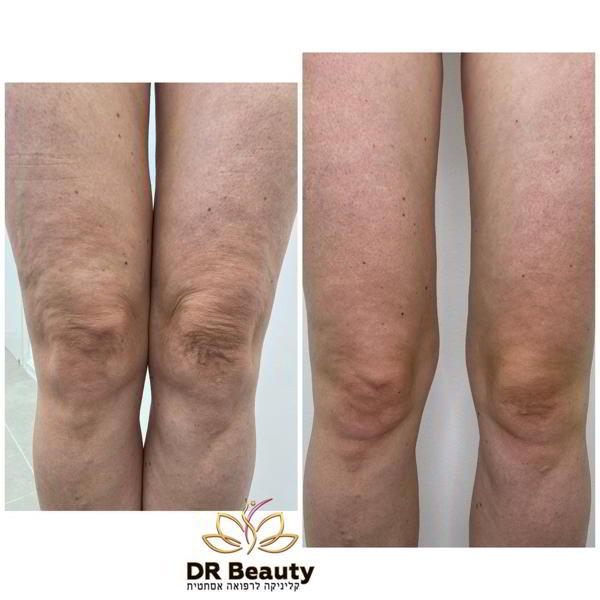 רפואה אסתטית / הזרקות קריית ביאליק - Dr Beauty ד"ר ביוטי מכון יופי