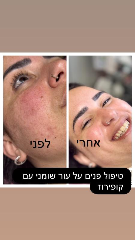 קוסמטיקה (ללא הזרקות) רחובות - Natali