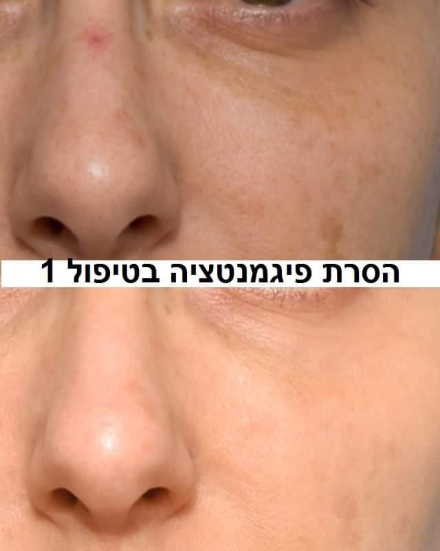 לייזר וטיפולים מכשירניים חיפה - פיור סקין – טיפולי קוסמטיקה מתקדמים