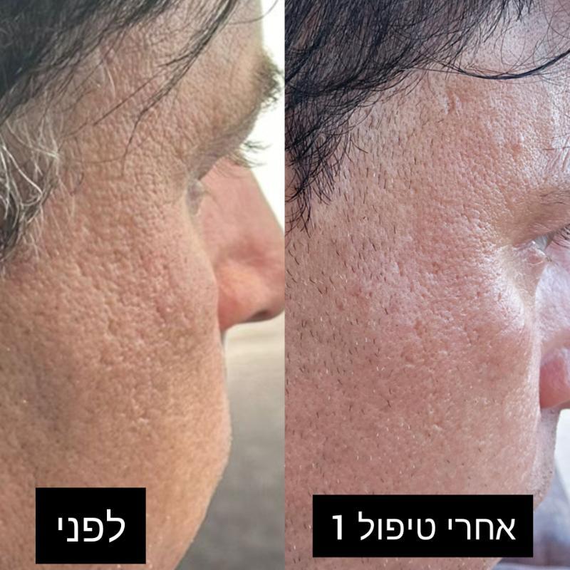 קוסמטיקה (ללא הזרקות) חיפה - פיור סקין – טיפולי קוסמטיקה מתקדמים