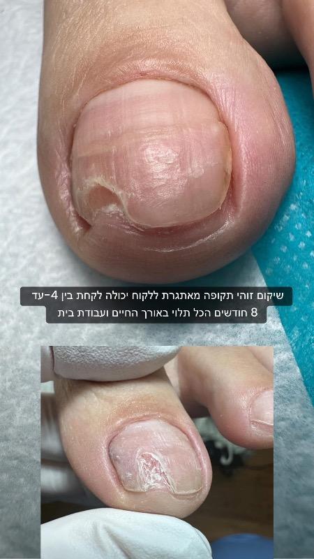 פודולוגיה רחובות - ויקטוריה דוידוב /פדיקור שיקומי עלפי פודולוגיה