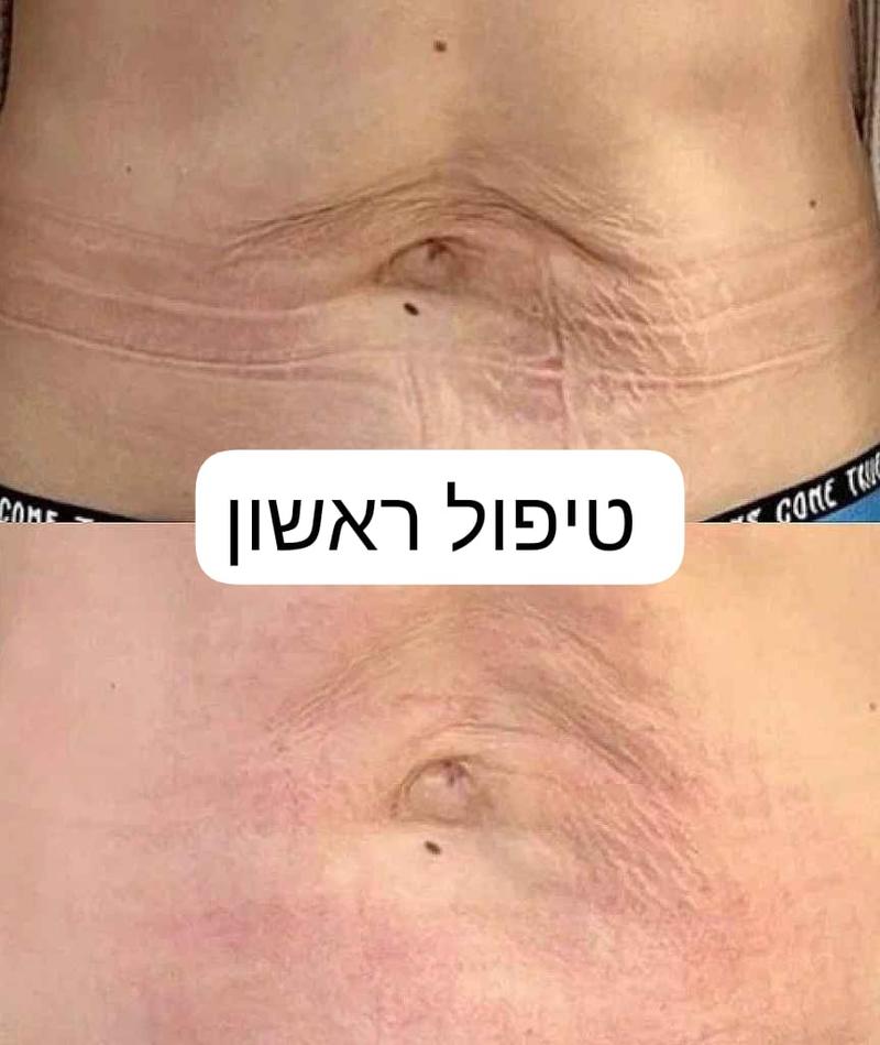 רפואה אסתטית / הזרקות בת ים - Ирина