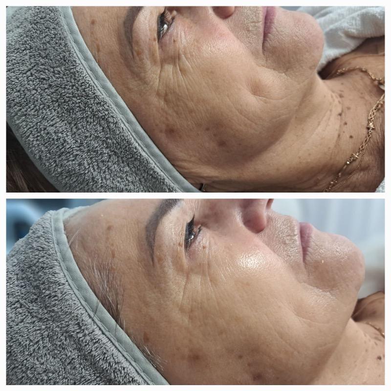 רפואה אסתטית / הזרקות ראשון לציון - Evgenia Cosmetologist