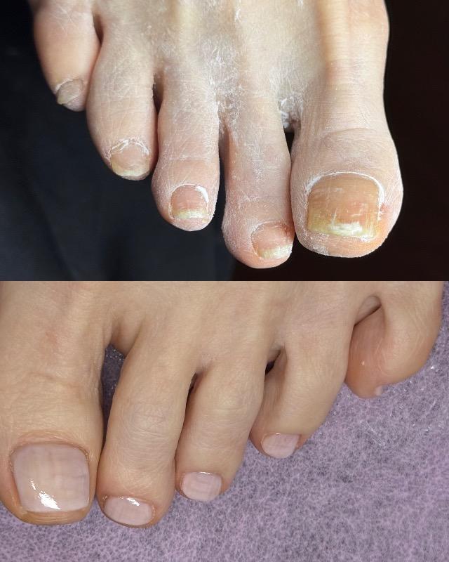 פודולוגיה בת ים - Katynails