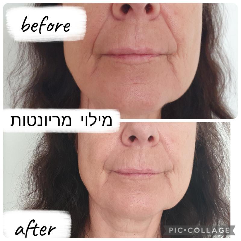 רפואה אסתטית / הזרקות רחובות -  Dr.Olga Perchyk 