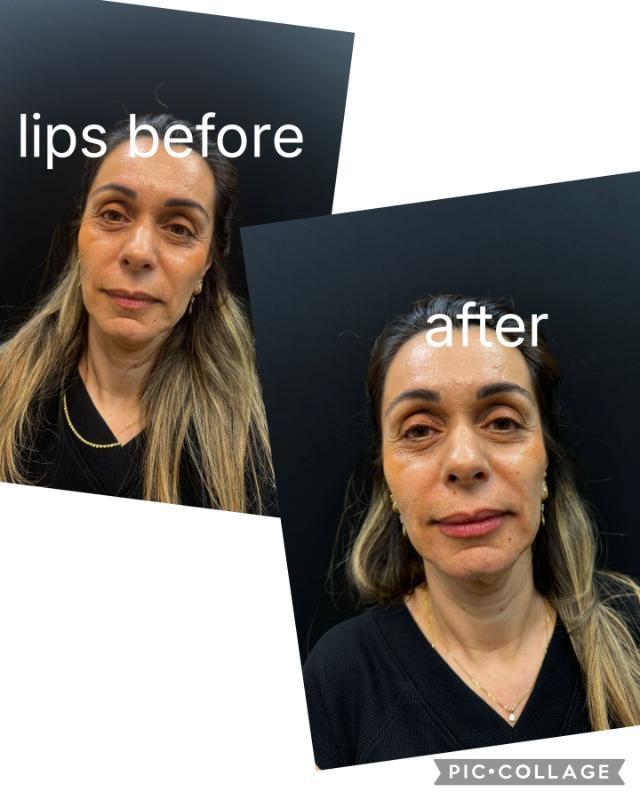 רפואה אסתטית / הזרקות רחובות -  Dr.Olga Perchyk 