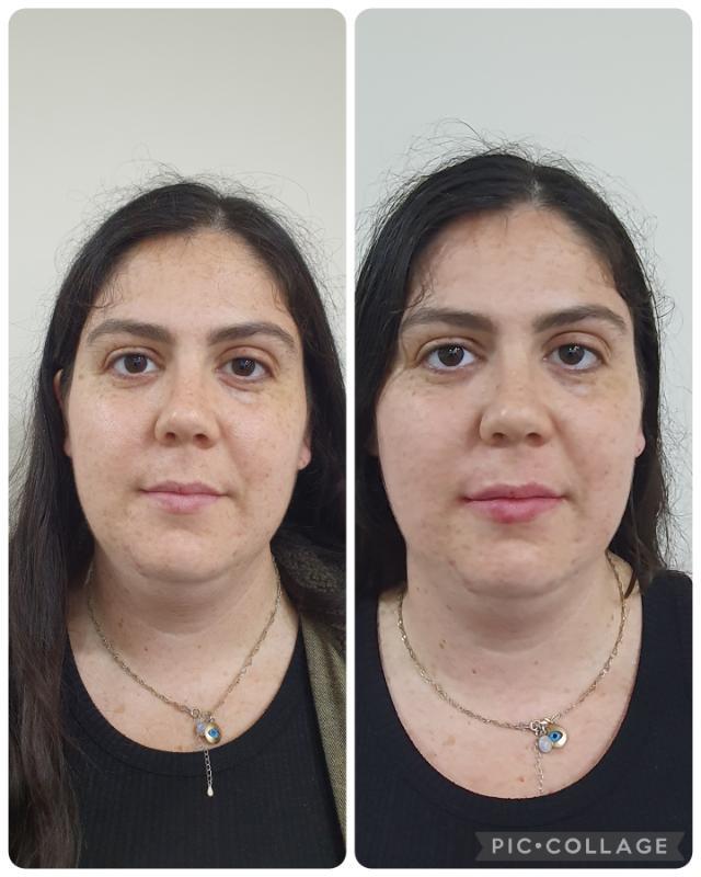 רפואה אסתטית / הזרקות רחובות -  Dr.Olga Perchyk 