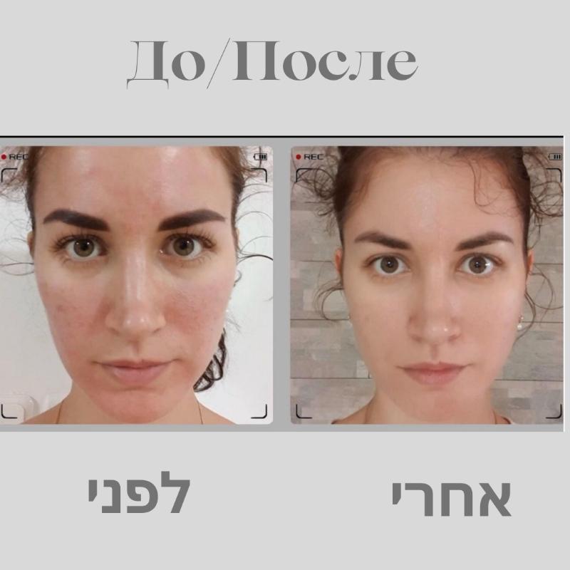 קוסמטיקה (ללא הזרקות) אשקלון - Katya D - cosmetologist