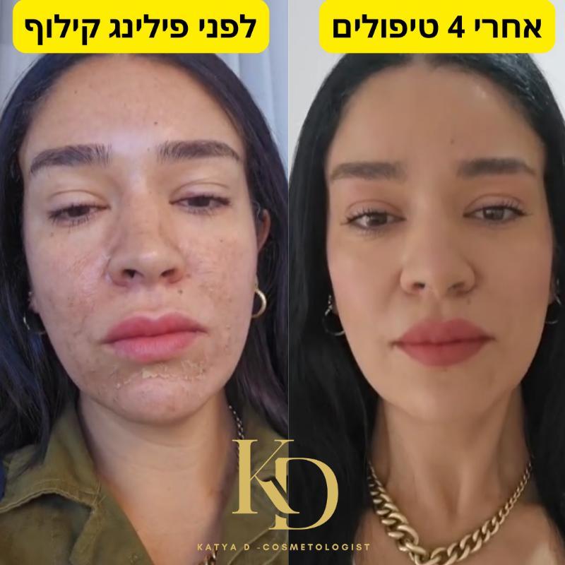 קוסמטיקה (ללא הזרקות) אשקלון - Katya D - cosmetologist