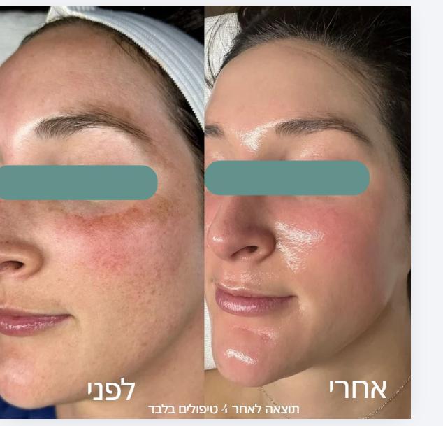 קוסמטיקה (ללא הזרקות) אשקלון - Katya D - cosmetologist