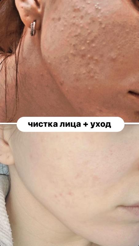 קוסמטיקה (ללא הזרקות) ראשון לציון - Veronika.skin.aesthetics