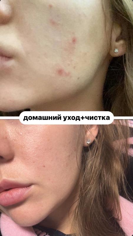 קוסמטיקה (ללא הזרקות) ראשון לציון - Veronika.skin.aesthetics